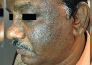 Acanthosis Nigricans- a skin condition prevalent in Vizag