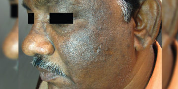 Acanthosis Nigricans- a skin condition prevalent in Vizag